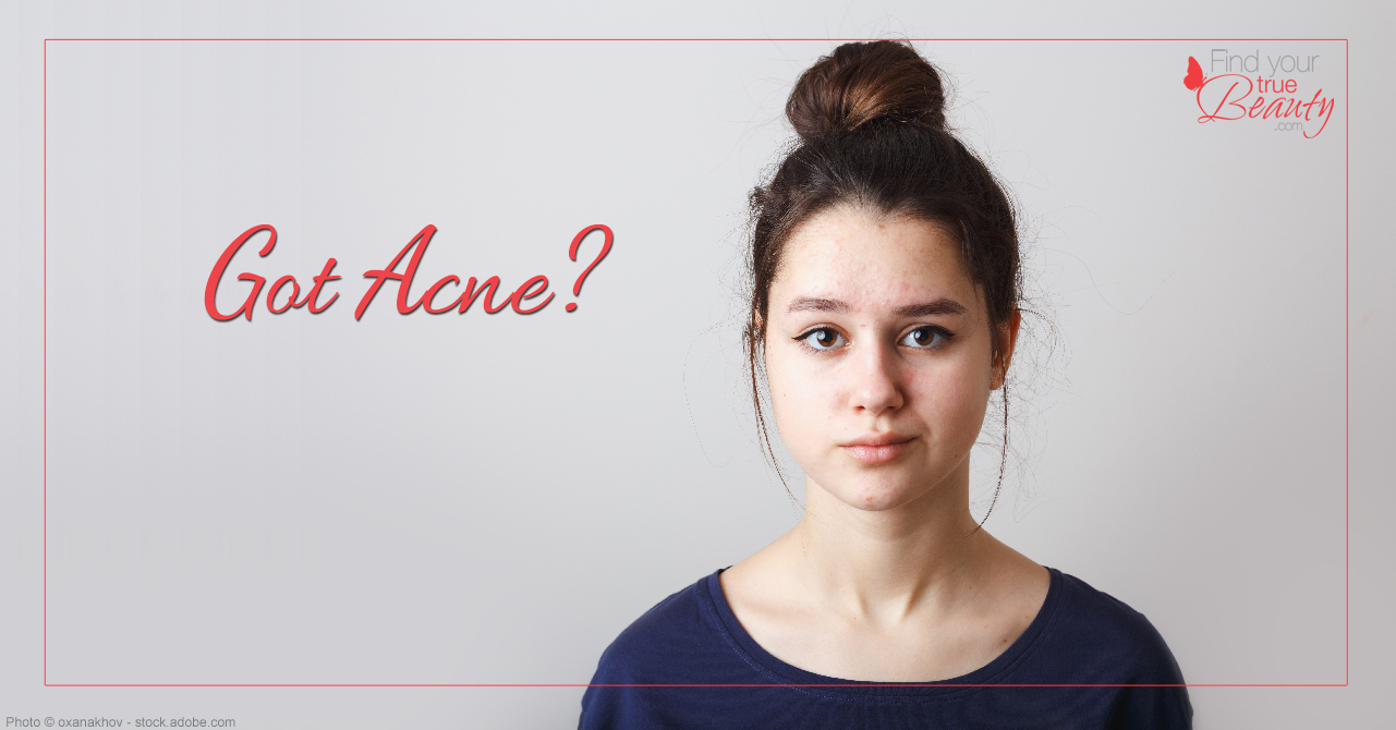 Got Acne?